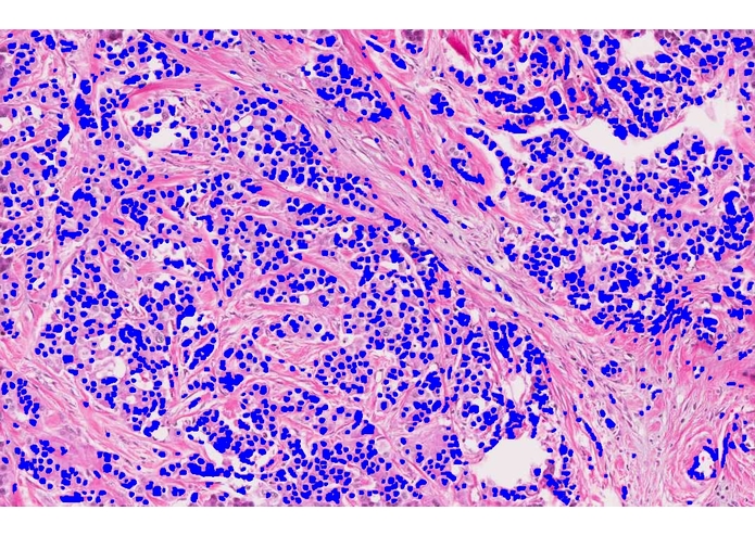 SVM Model for Accurate Breast Cancer Prognosis – screenshot 4