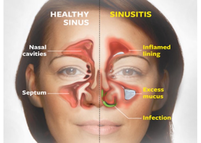 Chronic Sinus Problems Devpost