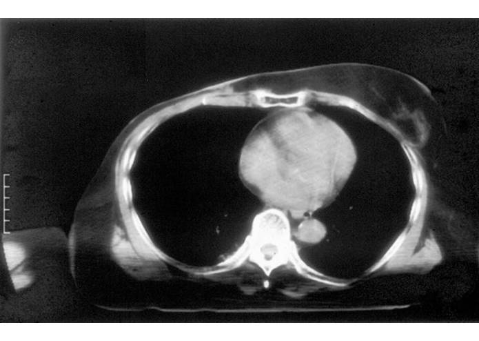 Heat-Targeted Drug Delivery Vest – screenshot 2