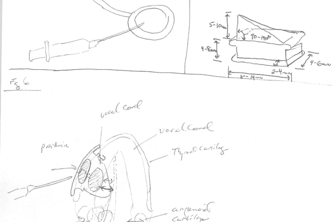 Adjustable Thyroplasty Implant