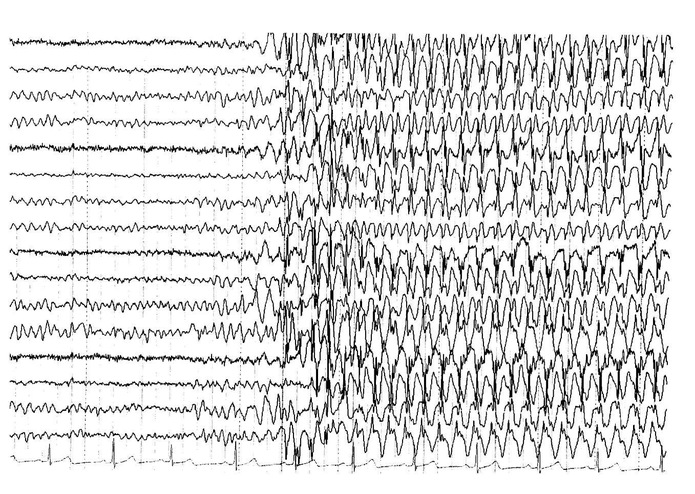 Forecasting Seizures With Neural Networks and EEGs – screenshot 1