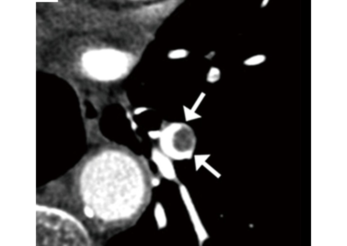 Early Detection of Pulmonary Embolism – screenshot 1