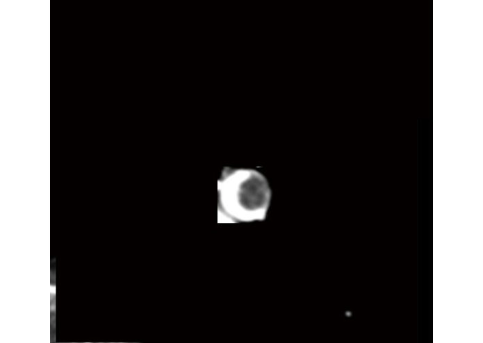 Early Detection of Pulmonary Embolism – screenshot 2