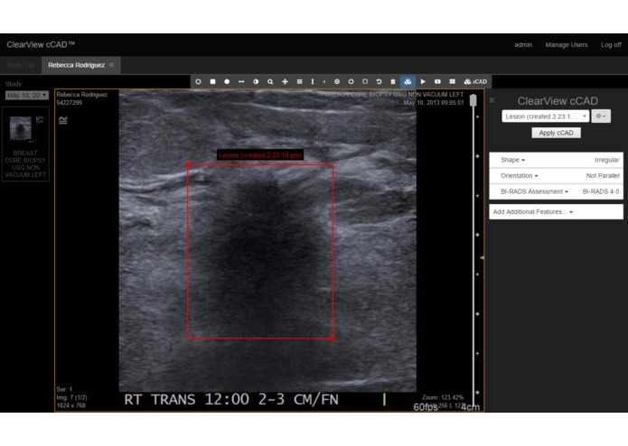 Breast Cancer Ultrasound Computer Assistant Diagnosis  – screenshot 1