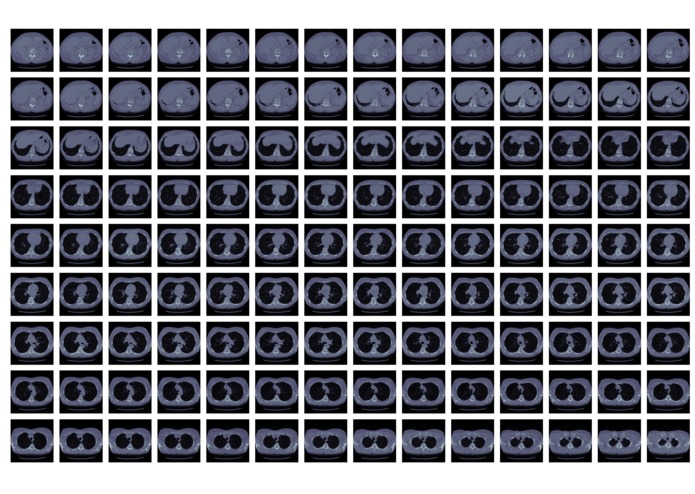 Lung Cancer Visualization & Detection – screenshot 1