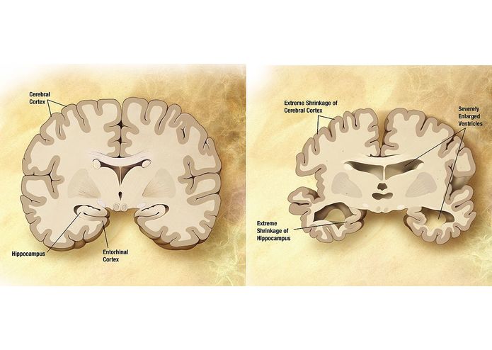 Imaging genetics for Alzheimer's disease – screenshot 1