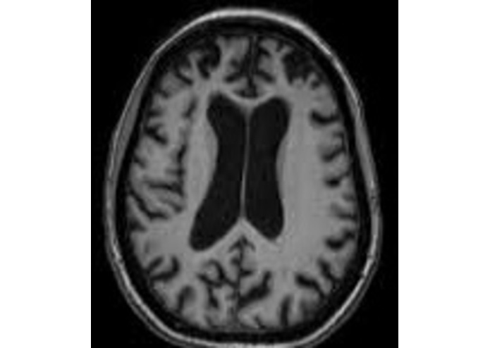 AlzheimerAnalyzer – screenshot 2