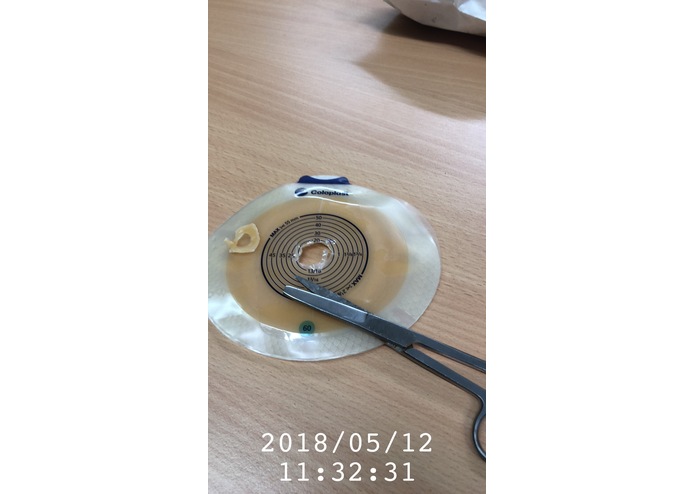 Stoma Cinch  – screenshot 6