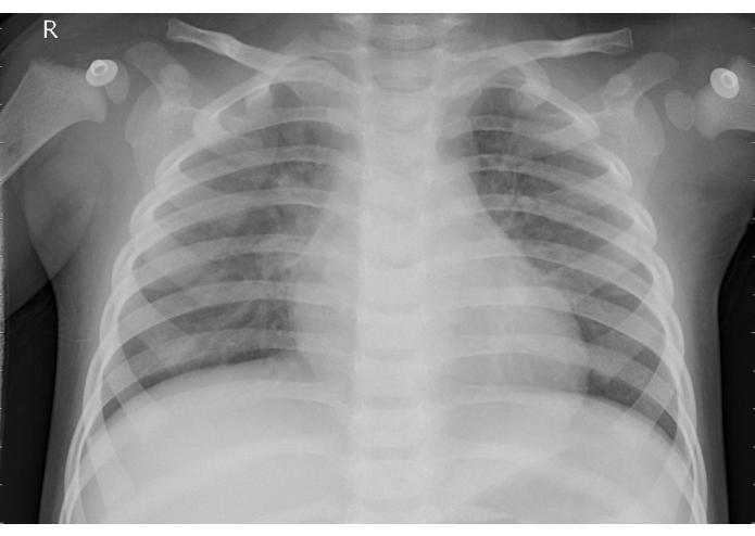 ChestXRai – screenshot 1