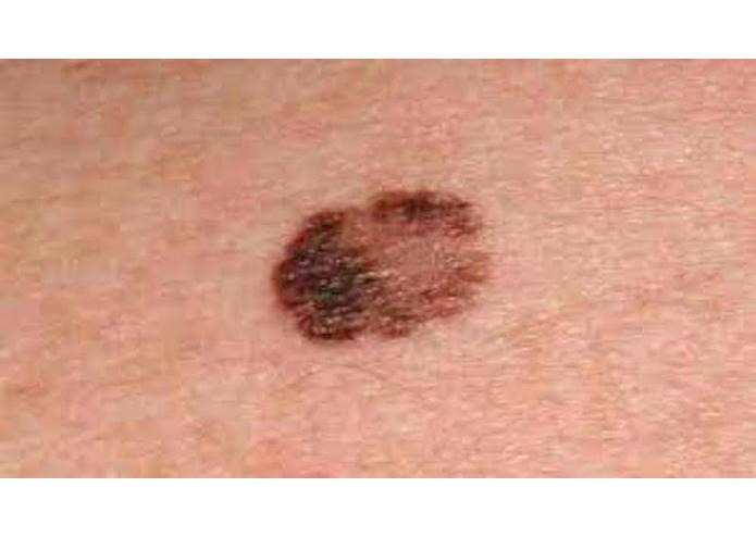 Skin Cancer/Melanoma Detector – screenshot 4