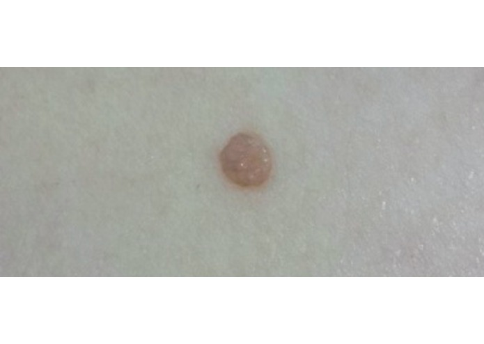 Skin Cancer/Melanoma Detector – screenshot 6