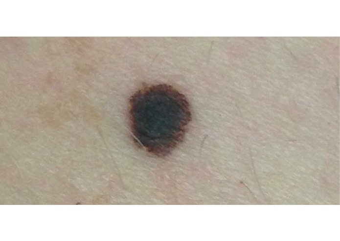 Skin Cancer/Melanoma Detector – screenshot 5