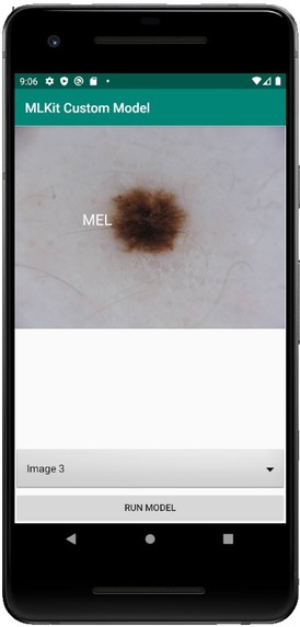 melanoma model – screenshot 3