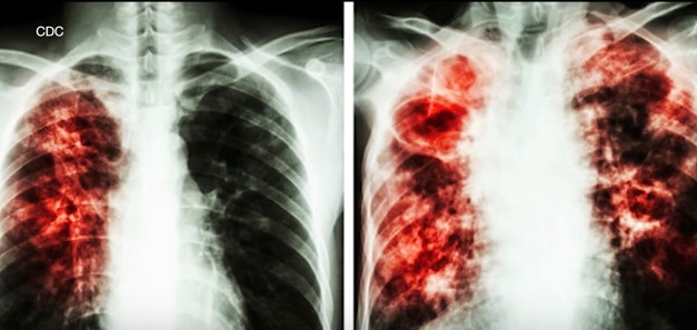 World Health Organization news on coronavirus effected  – screenshot 2