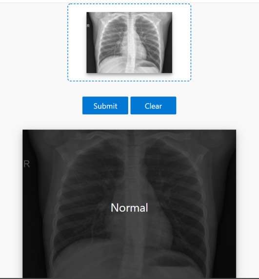 Pneumonia Detection – screenshot 3