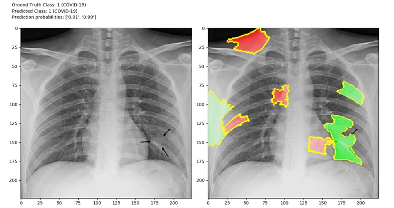 COVID-CXR – screenshot 1