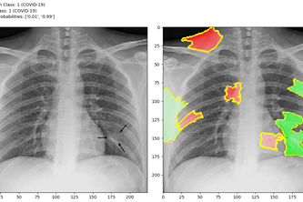 COVID-CXR
