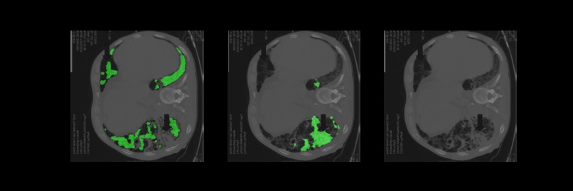 Covid-19 Medical Segmentation – screenshot 6