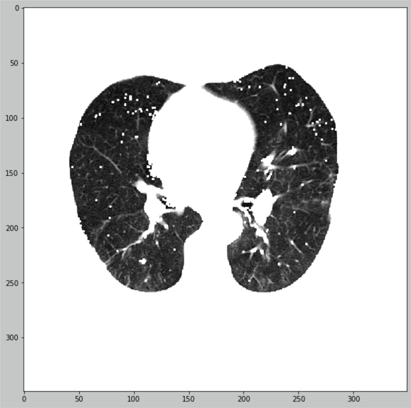 Automated classification for COVID-19 pneumonia – screenshot 2