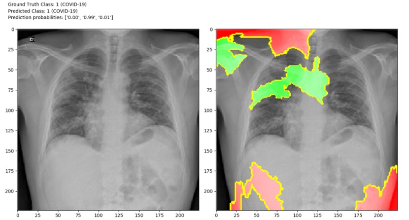 Detection of COVID-19 – screenshot 1