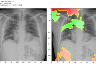 Detection of COVID-19