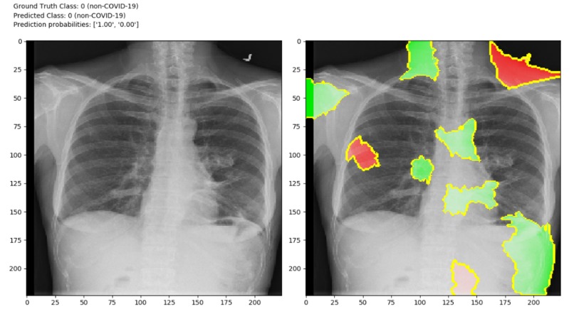 Detection of COVID-19 – screenshot 2