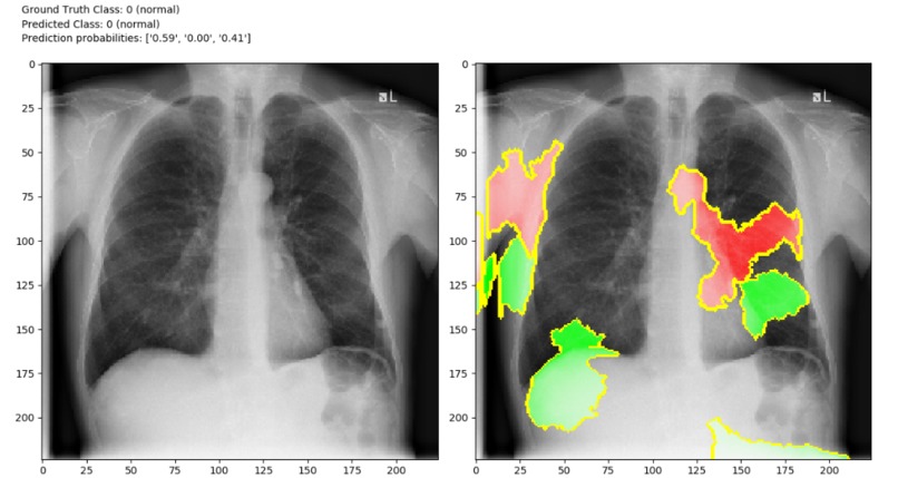 Detection of COVID-19 – screenshot 4