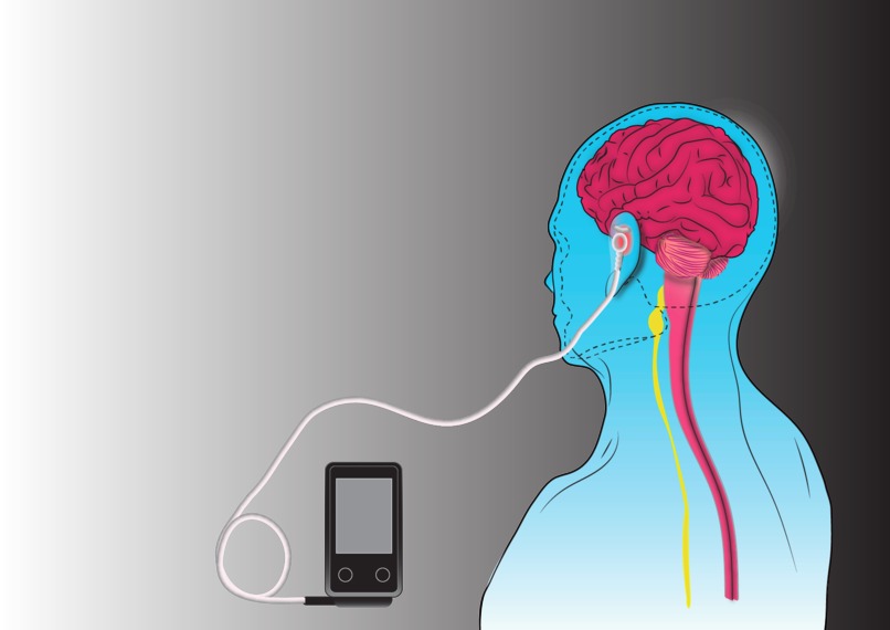 vagus nerve stimulation for cytokine storm in COVID-19 – screenshot 1