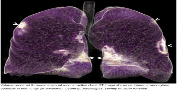  Accurate Diagnosis of COVID-19 Using CT Scan and AI – screenshot 1