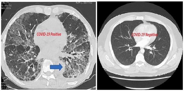  Accurate Diagnosis of COVID-19 Using CT Scan and AI – screenshot 2
