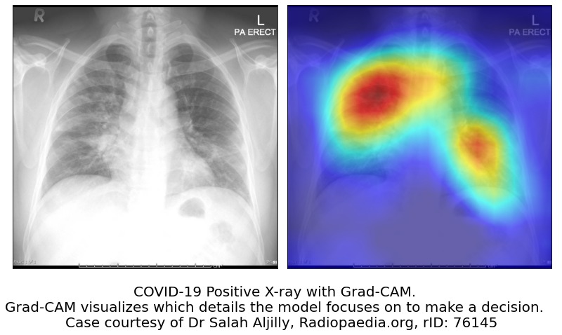 COVID X-Ray Triage Assistant – screenshot 1