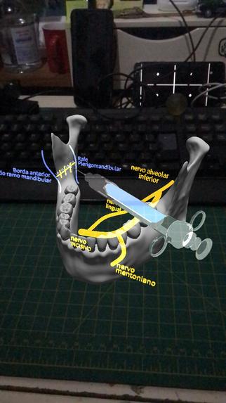 The technique of anesthesia of the lower alveolar nerve. – screenshot 1