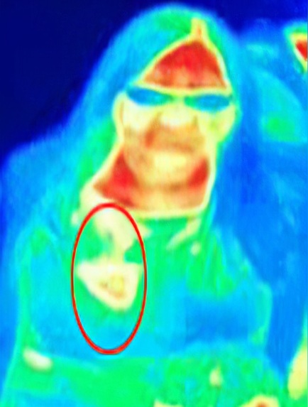 Detecting breast cancer with smartphone – screenshot 1