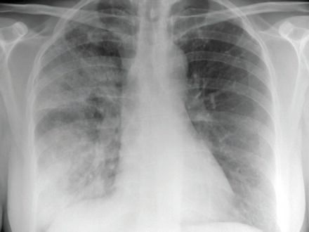 pneumonia_detection – screenshot 6