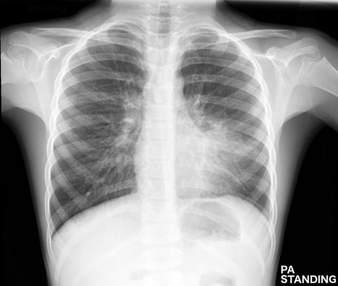pneumonia_detection – screenshot 7