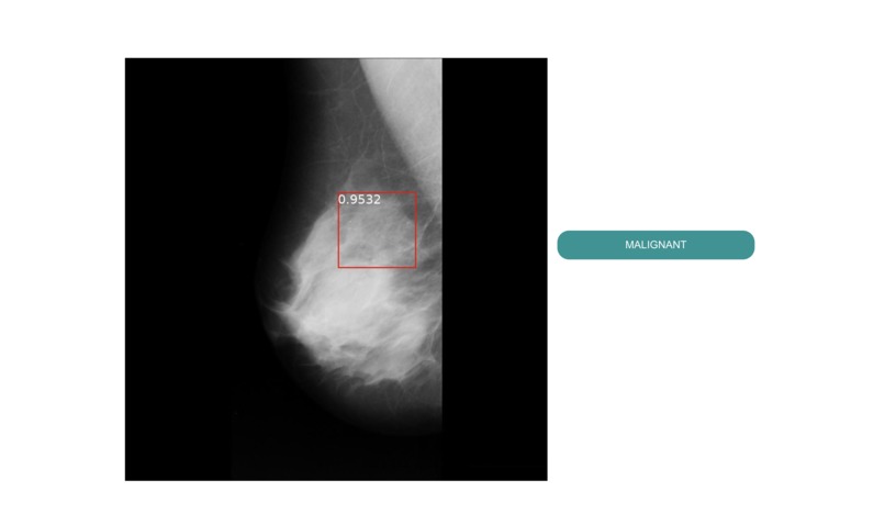 MEdiScan: Breast Lesion detection – screenshot 5
