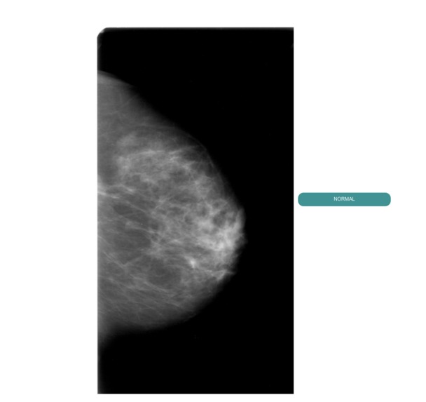 MEdiScan: Breast Lesion detection – screenshot 6