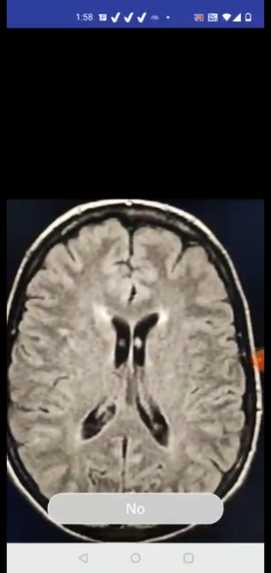 Brain Tumor Detector – screenshot 1