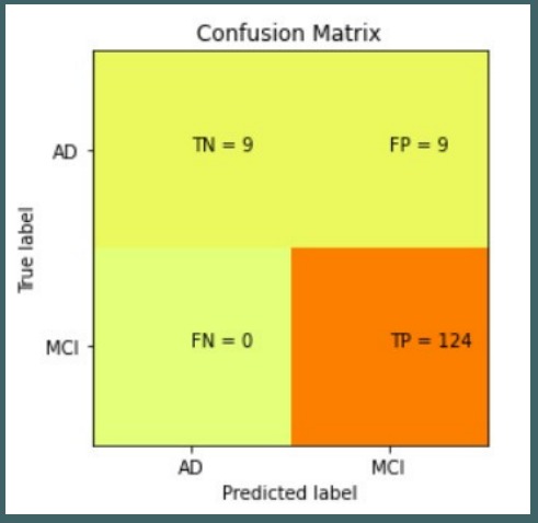 Early on-set detection of Alzheimer's disease from MRI scan – screenshot 3