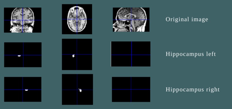 Early on-set detection of Alzheimer's disease from MRI scan – screenshot 2