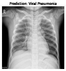 COVID-19 Detection through Radiography images of Lung CT. – screenshot 5