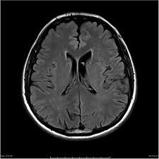 brain-cancer detection – screenshot 1