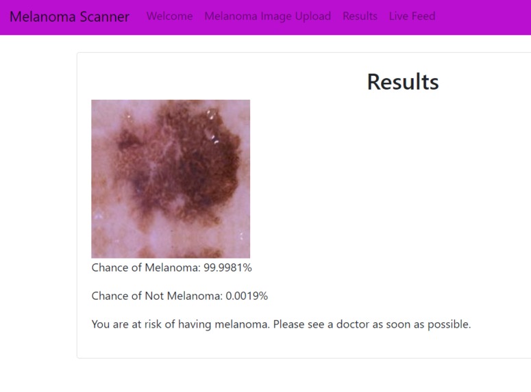 Melanoma Detection – screenshot 1