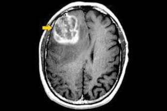 Brain tumour image segmentation using deep learning