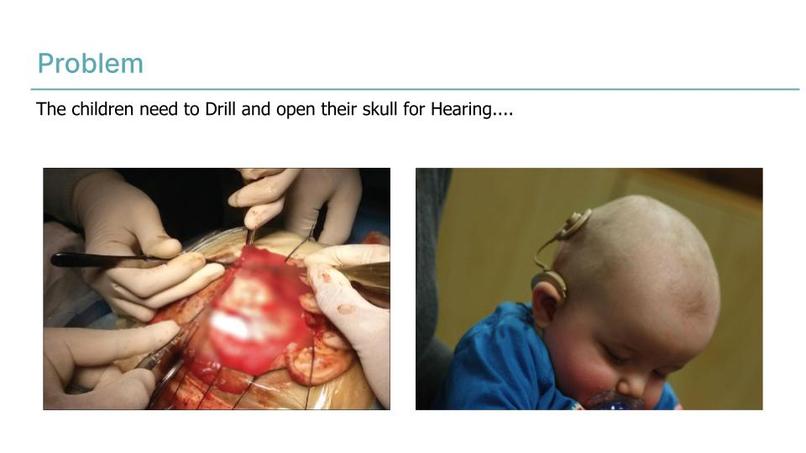 Adhesive Non Surgical Hearing Device – screenshot 2