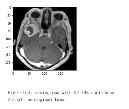 Brain MRI tumor classification – screenshot 1