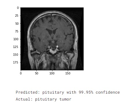 Brain MRI tumor classification – screenshot 2