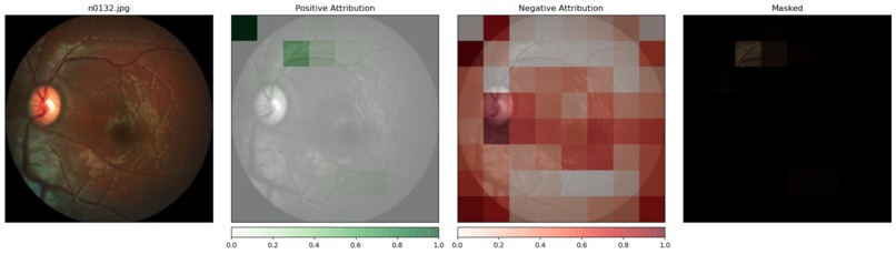 Primary Open Angle Glaucoma: Deeplearning Assisted Diagnosis – screenshot 2