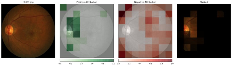 Primary Open Angle Glaucoma: Deeplearning Assisted Diagnosis – screenshot 5
