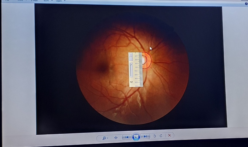 Primary Open Angle Glaucoma: Deeplearning Assisted Diagnosis – screenshot 7